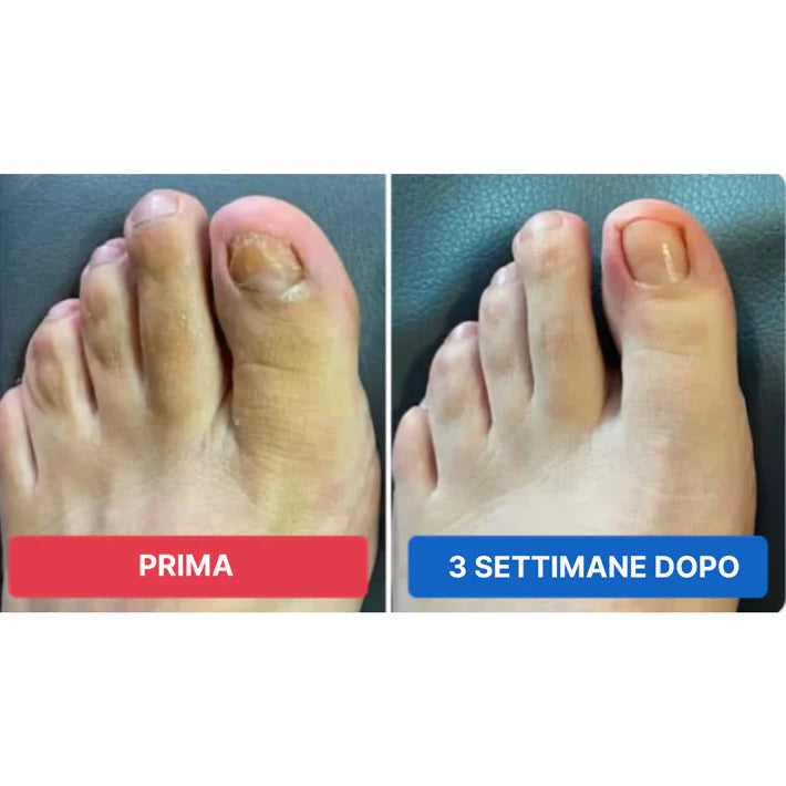 Cerotti per unghie fungine